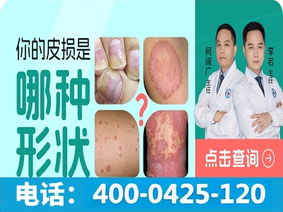 苏州哪个医院治银屑病好